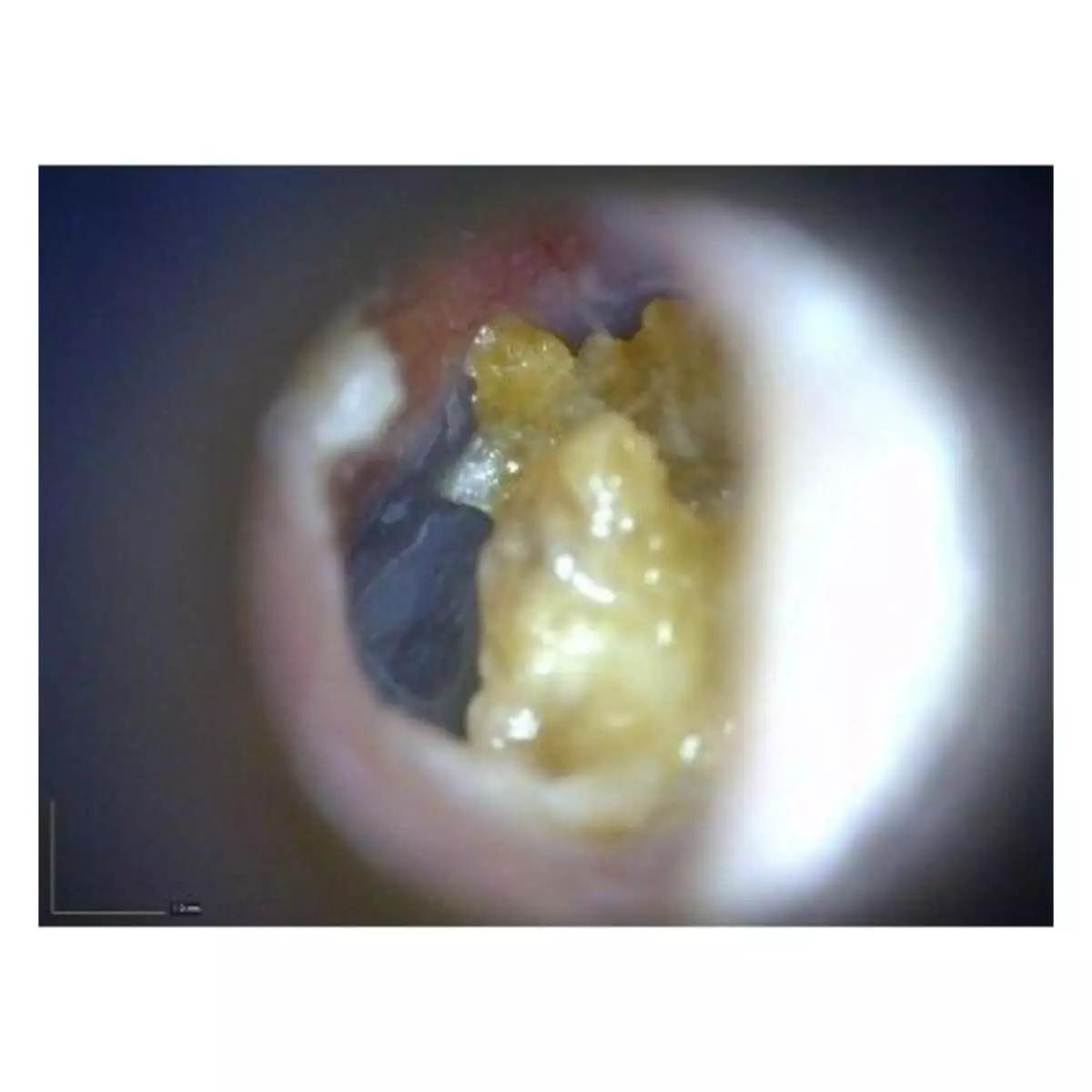  EarScope Pro wireless video otoscope