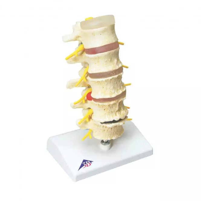  Herniated Disc
