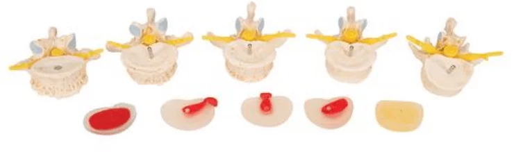  Herniated Disc