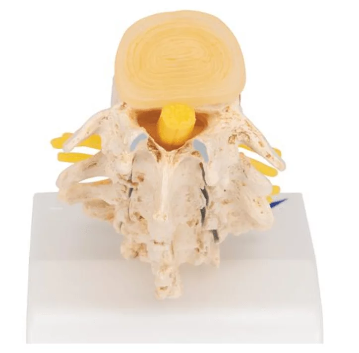  Herniated Disc