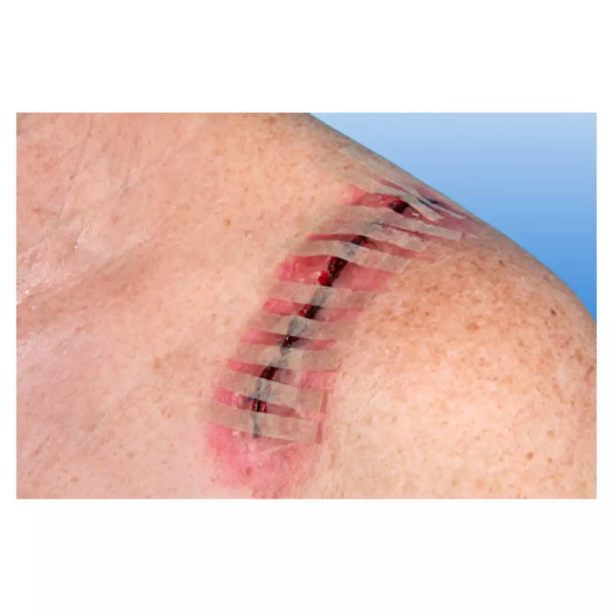  RUDANAHT sterile wound closure strips