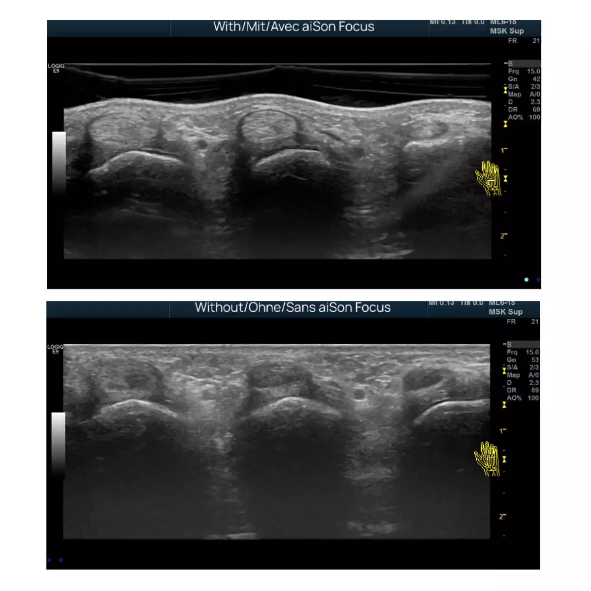  aiSon FOCUS gel pads for ultrasound scanners