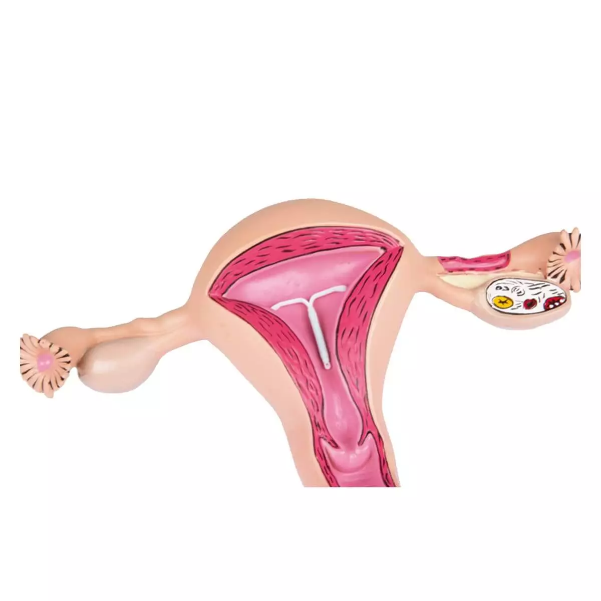  Uterus model