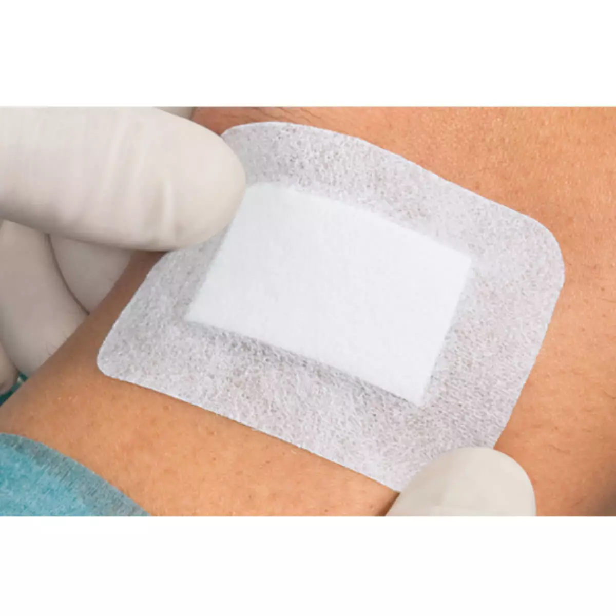  Cosmopor Advance wound dressing