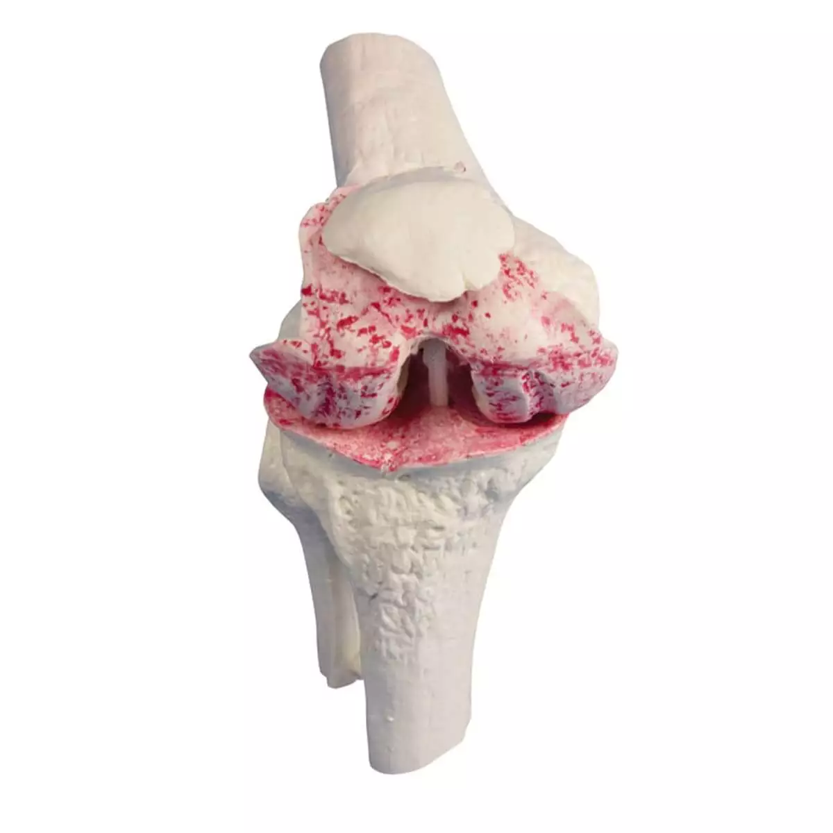 Knee implant model