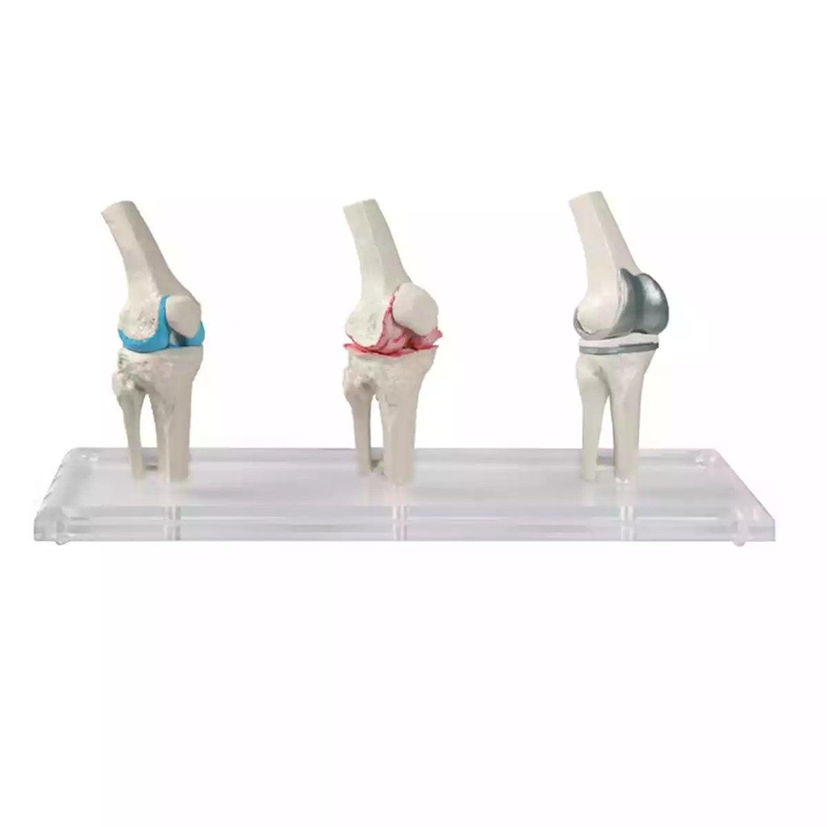  Knee implant model