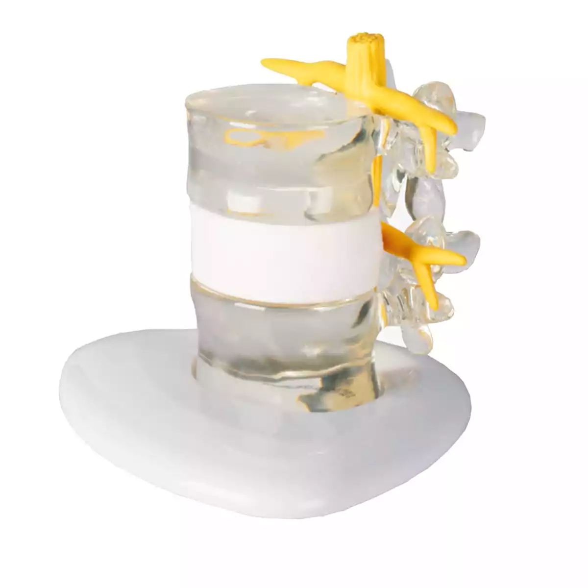  Herniated disc simulator