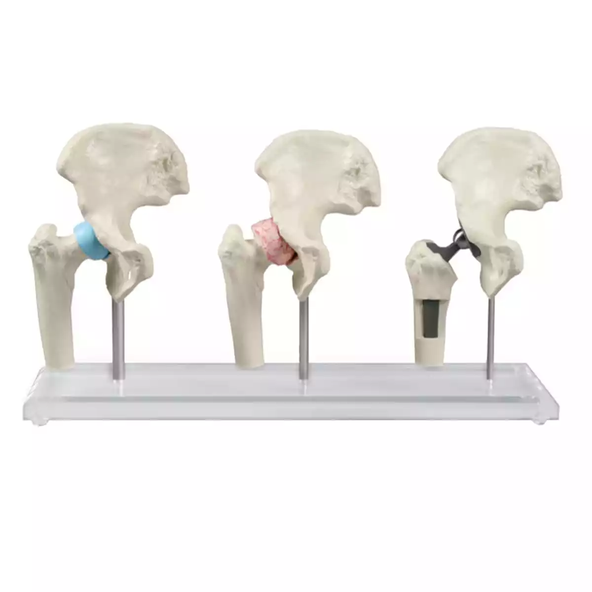  Hip implant model