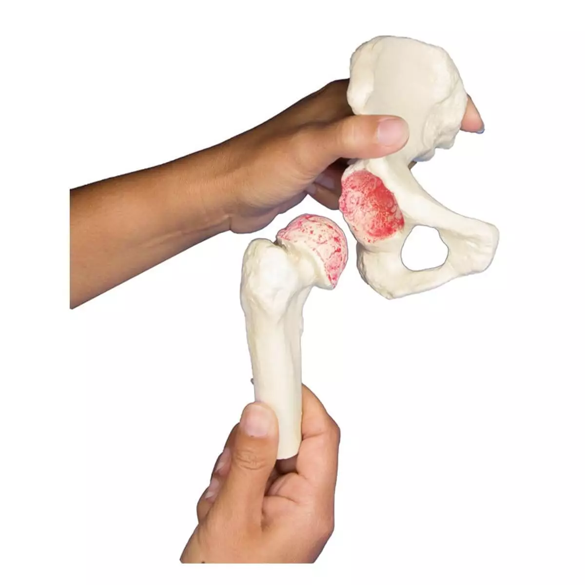  Hip implant model