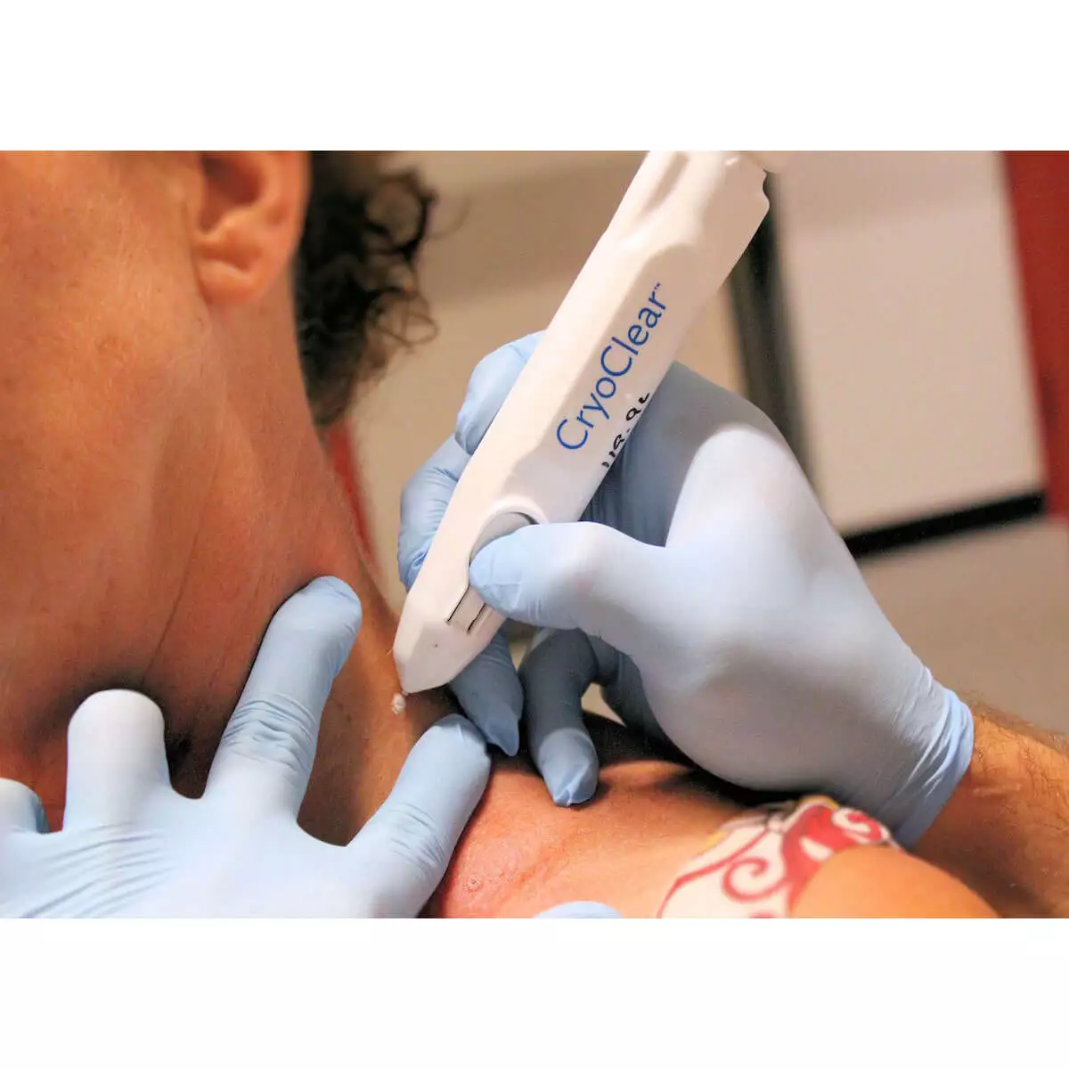  CryoClear cryotherapy